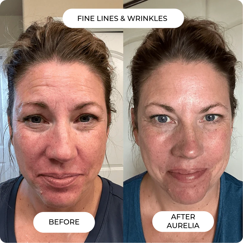 Aurelia Micro Infusion System