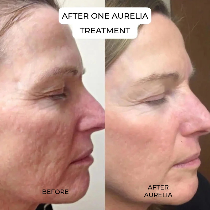 Aurelia Micro Infusion System