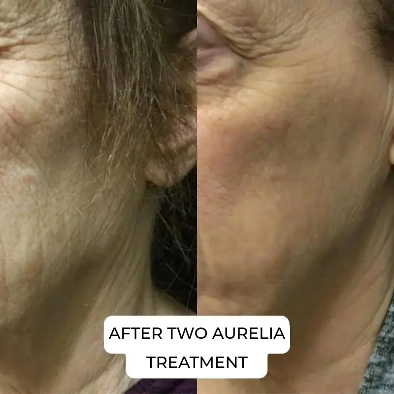 Aurelia Micro Infusion System