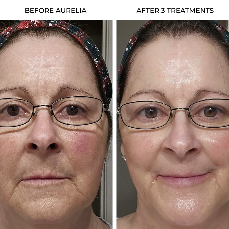 Aurelia Micro Infusion System